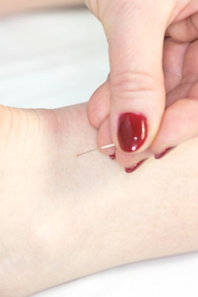 Acupuncture Tips and Holistic Medicine Insights